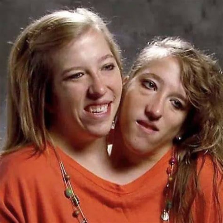 Conjoined Twins Abby and Brittany Hensel Decide on Procreation